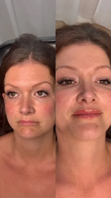 Dermaplaning Facial
