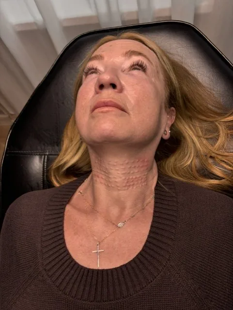 Microneedling