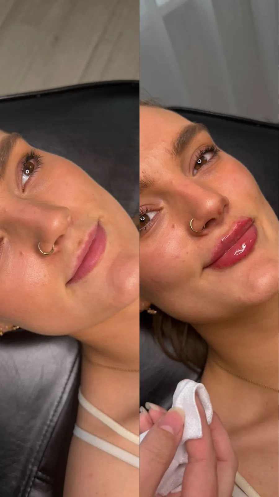 Lip Filler